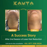 Laser Hair Reduction in Jaipur