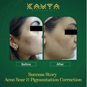 Summer Pigmentation Treatment