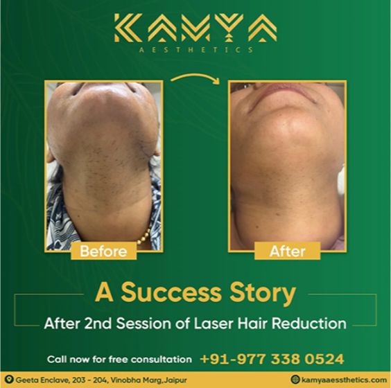 Laser Hair Reduction in Jaipur