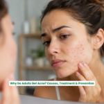 Adult woman with adult acne and clear skin contrast, showing professional acne treatment and healthy glowing skin at a modern aesthetic skin clinic in Jaipur.